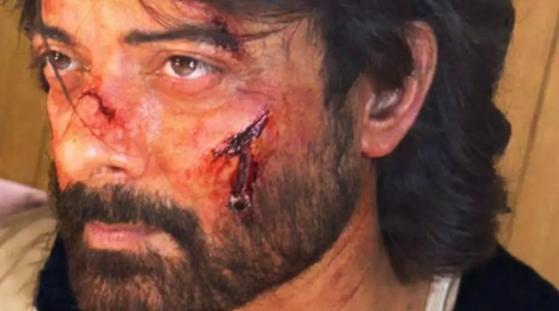 A bloody and bruised Rahul Bhat shoots for his next Netflix project
